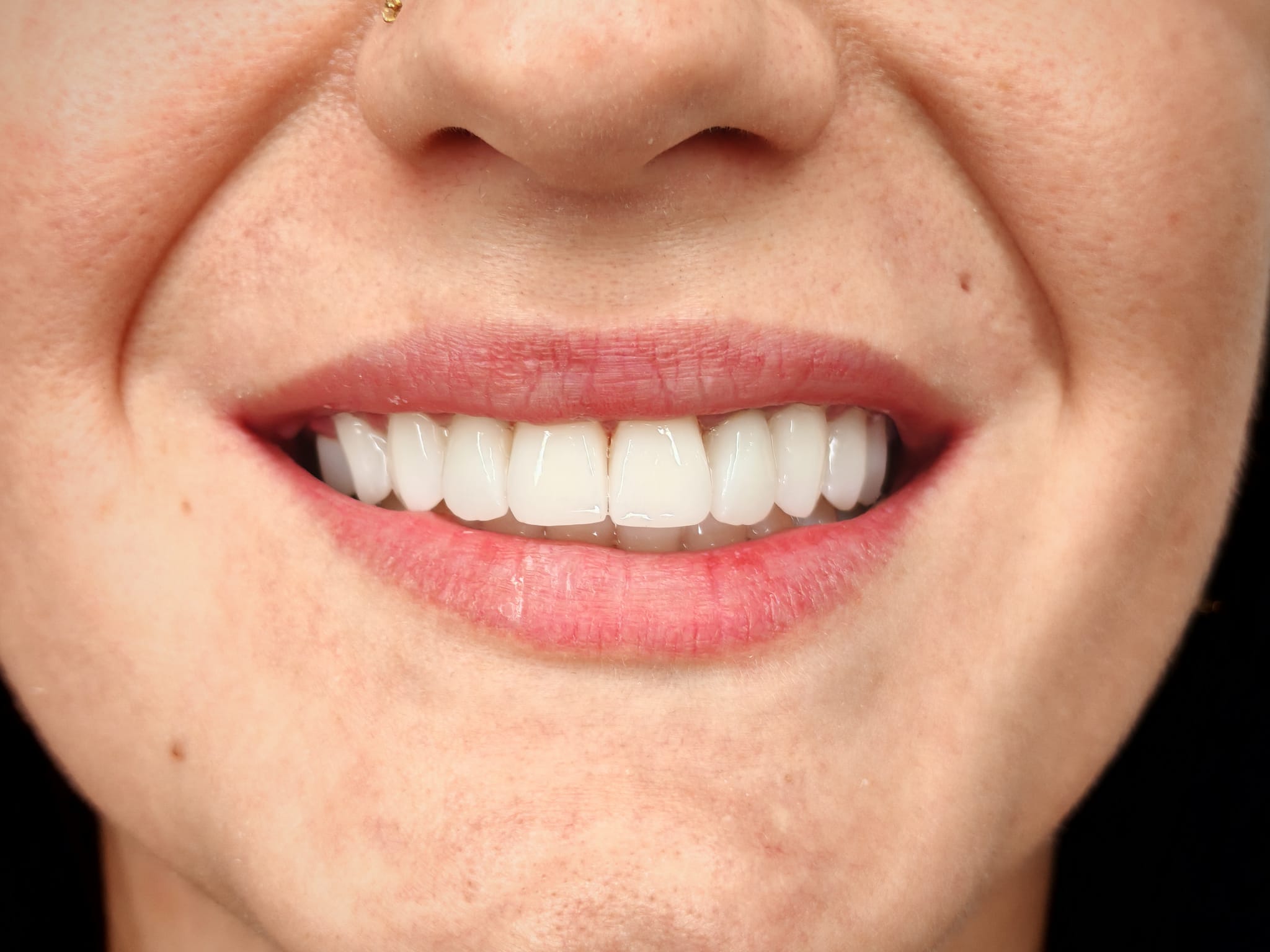 Close-up of a finished anterior restoration
