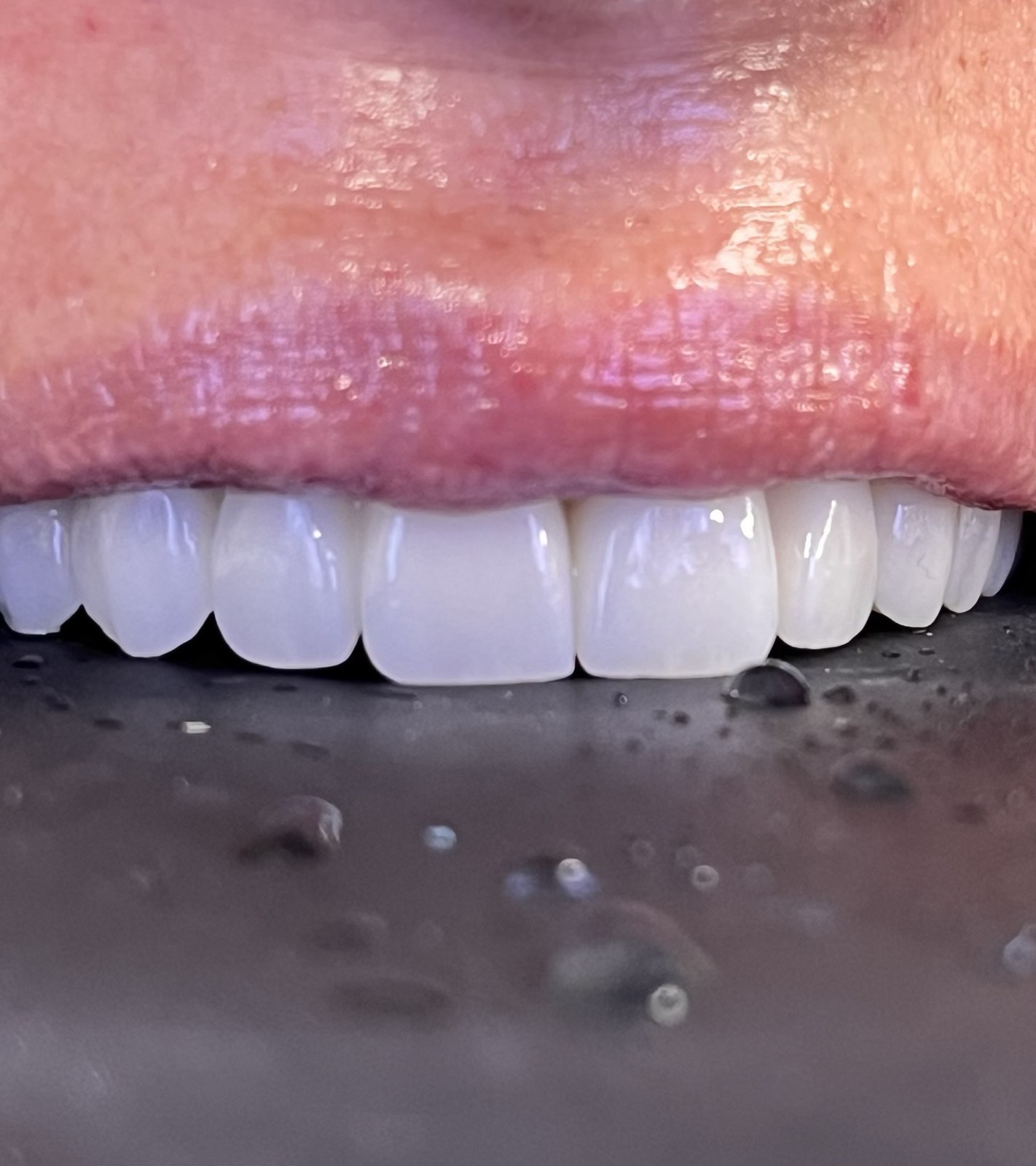 Anterior teeth with a retractor, finished work