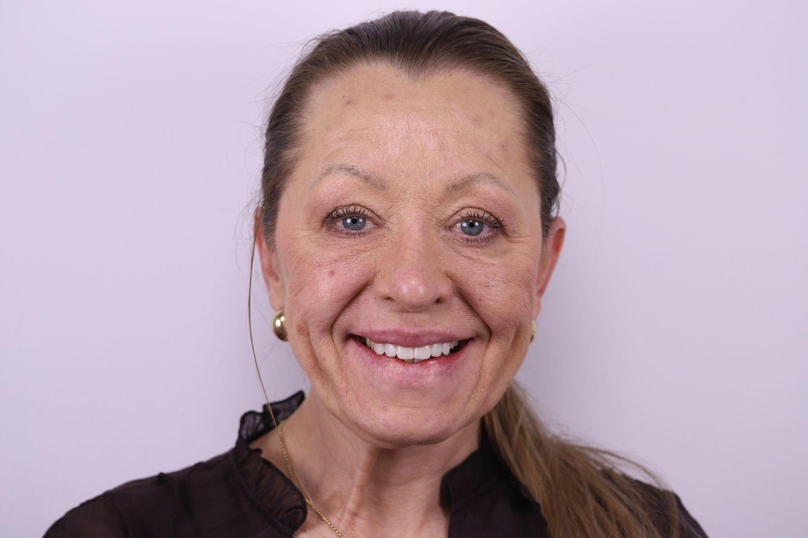 Patient after a completed prosthetic restoration