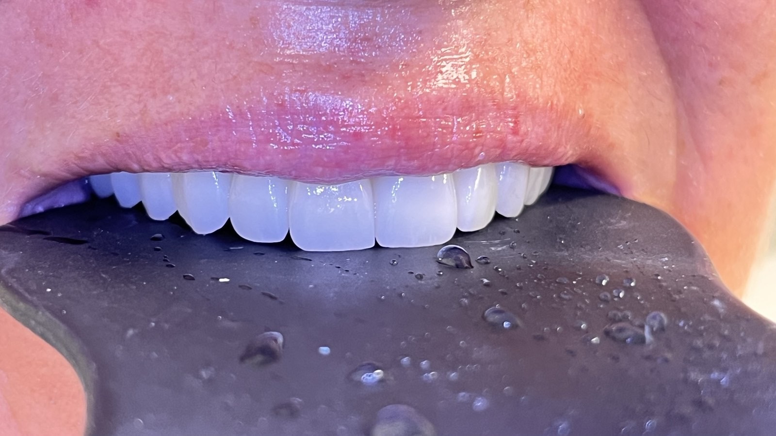 Close-up of a finished anterior restoration