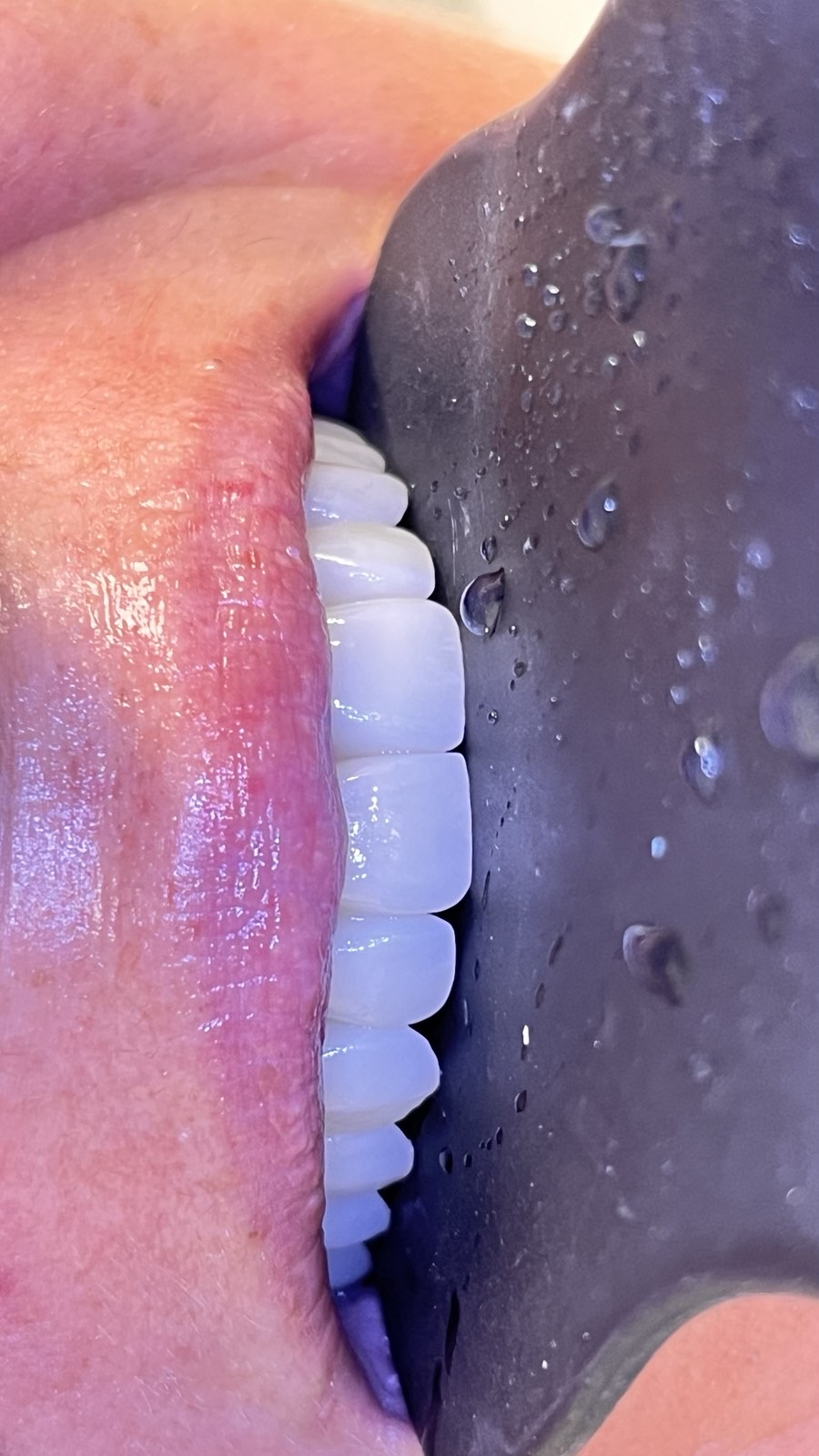 Lateral view of finished veneers